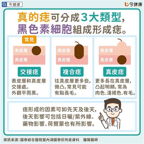 痣突出來|是痣or皮膚癌？醫「1張圖秒對照」 長這2部位最危險